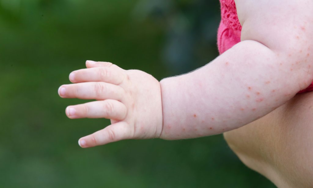First measles case reported in Alabama